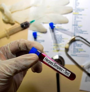 Photo of a herpes blood test Photo of a herpes blood test